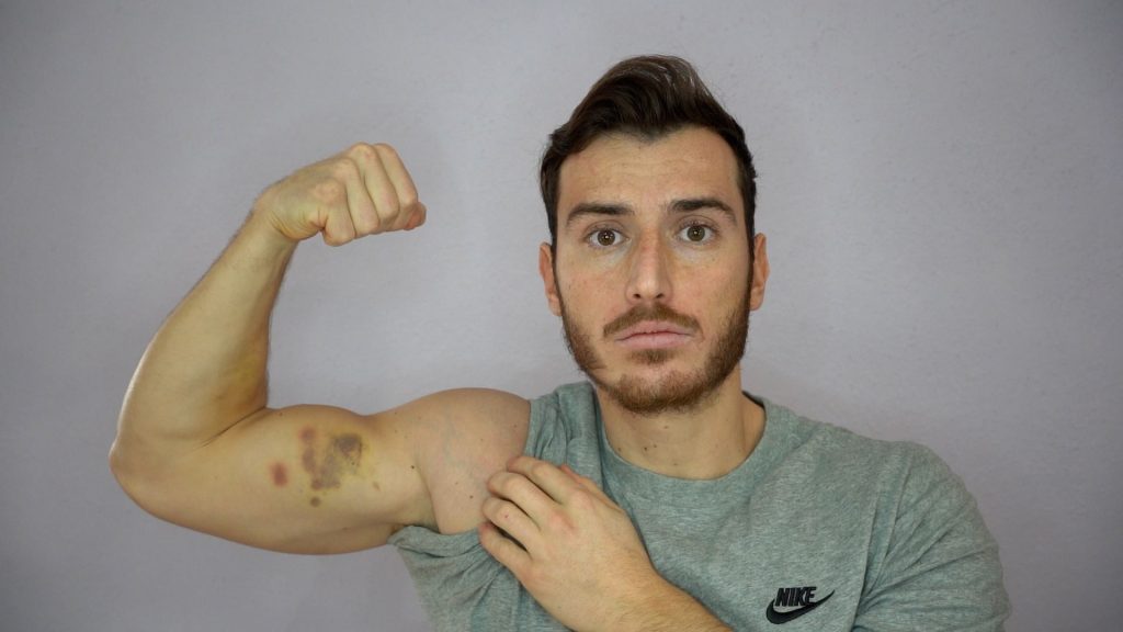 Homme sportif montrant son biceps contracté et couvert d'hématome après une blessure